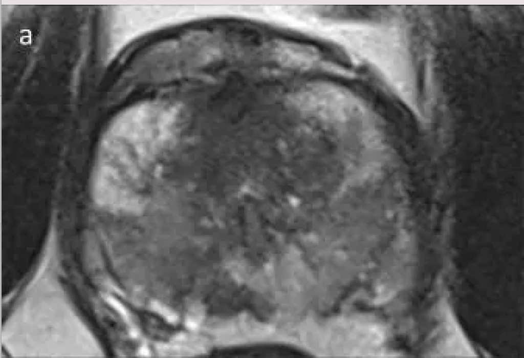 Study: 66 Percent of Men with Positive MRI for Prostate Cancer Had Normal PSA Levels