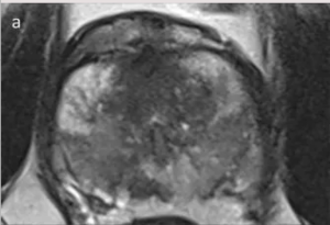 Study: 66 Percent of Men with Positive MRI for Prostate Cancer Had Normal PSA Levels